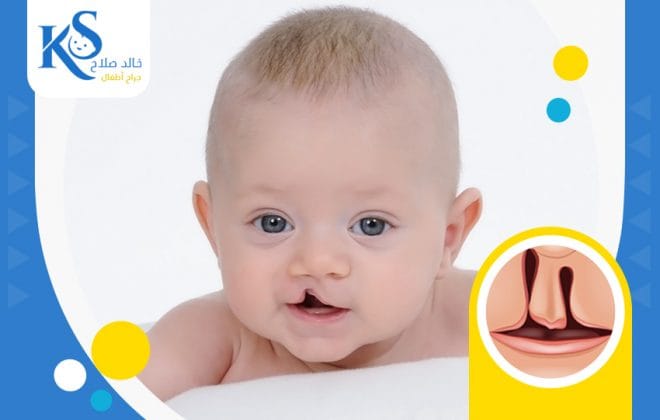 علاج الشفه الارنبيه بالليزر