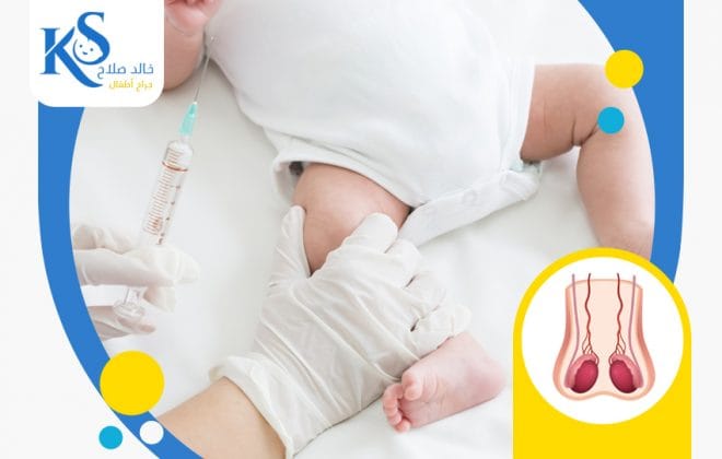 تكلفة عملية الخصية المعلقة