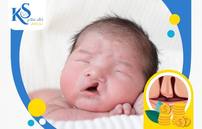 تكلفة عملية الشفة الارنبية في مصر
