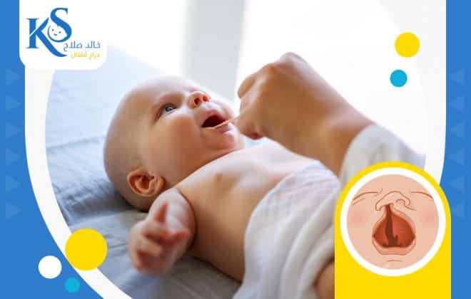 عملية سقف الحلق المفتوح