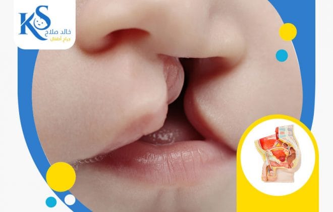 اسباب الشفة الارنبية وعلاجها 2 اسباب الشفة الارنبية