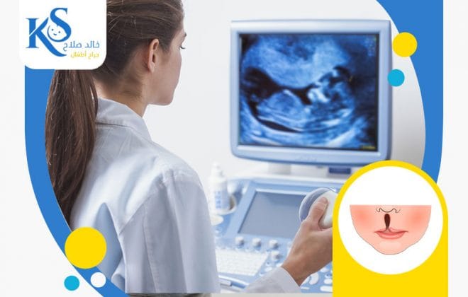 الشفة الارنبية في السونار