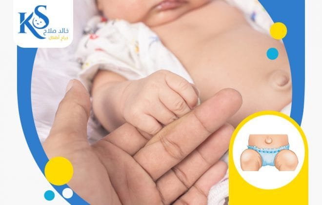 أسباب فتق السرة عند الرضع 2 اسباب فتق السرة عند الرضع