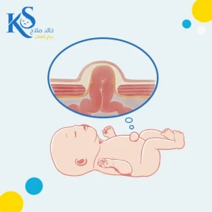 فتق السرة عند الاطفال حديثي الولادة: لا داعي للقلق! 3 شكل فتق السرة عند حديثي الولادة