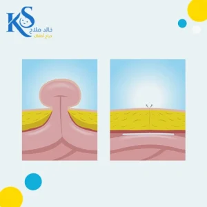 فتق السرة عند الاطفال حديثي الولادة: لا داعي للقلق! 4 شكل فتق السرة عند حديثي الولادة