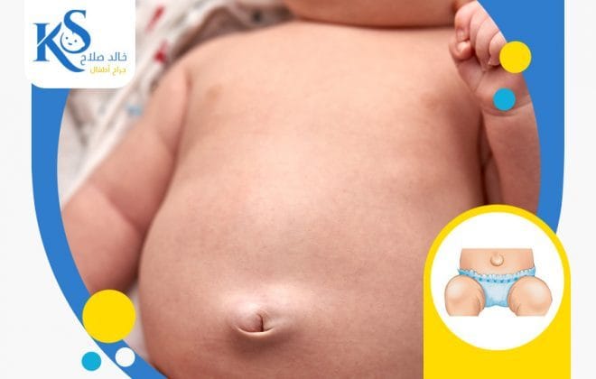 فتق السرة عند الاطفال حديثي الولادة: لا داعي للقلق! 3 فتق السرة عند الرضع