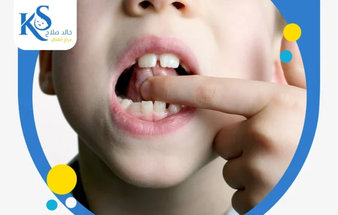 علاج ربط اللسان عند الاطفال