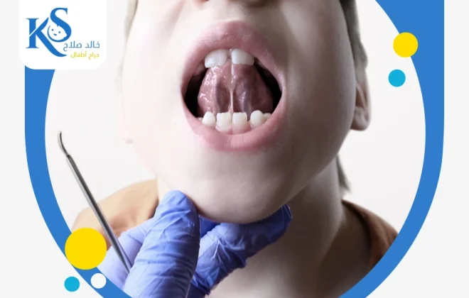 كل ما تريد معرفته عن جراحة اللسان المربوط للاطفال 3 جراحة اللسان المربوط للاطفال