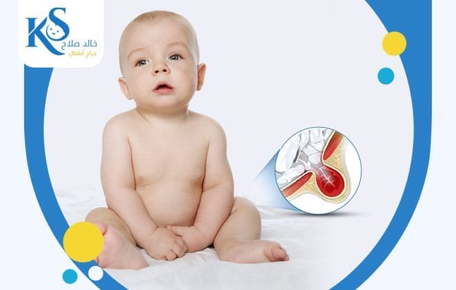 الفتق الإربي في الخصية عند الأطفال